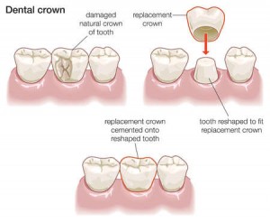 crowns