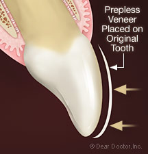 prepless-veneer