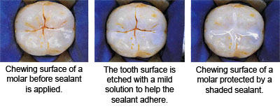 sealant1